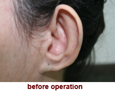 plastic-surgery-prominent-ear 